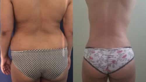 tummy tuck colombia 257-6-min