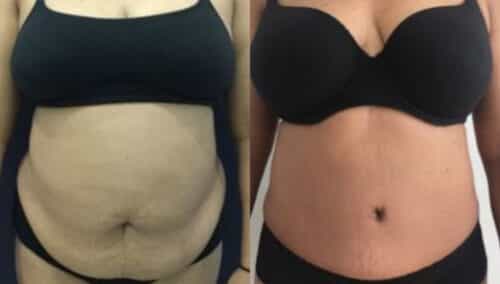 tummy tuck colombia 259-1-min