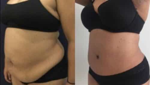 tummy tuck colombia 259-2-min