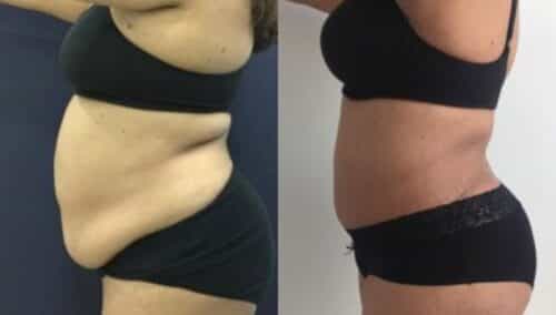 tummy tuck colombia 259-3-min