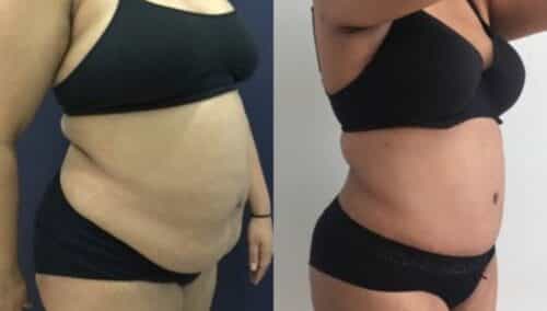 tummy tuck colombia 259-4-min