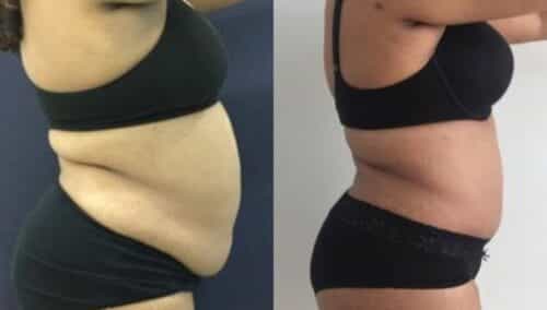 tummy tuck colombia 259-5-min