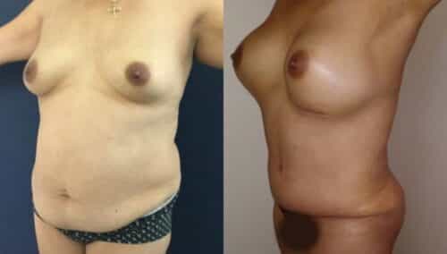 tummy tuck colombia 261-2-min
