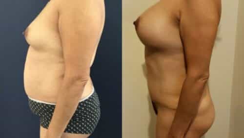 tummy tuck colombia 261-3-min