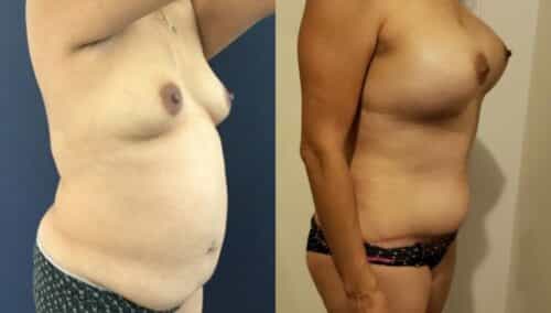 tummy tuck colombia 261-4-min