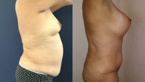 tummy tuck colombia 261-5-min