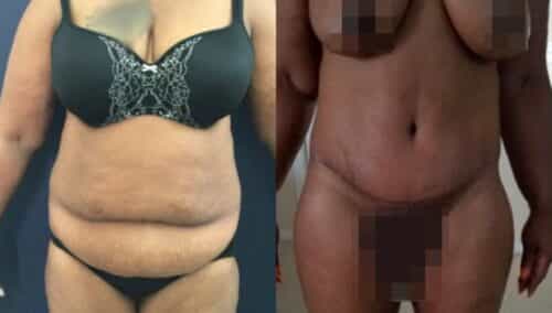 tummy tuck colombia 262-1-min