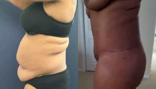 tummy tuck colombia 262-2-min