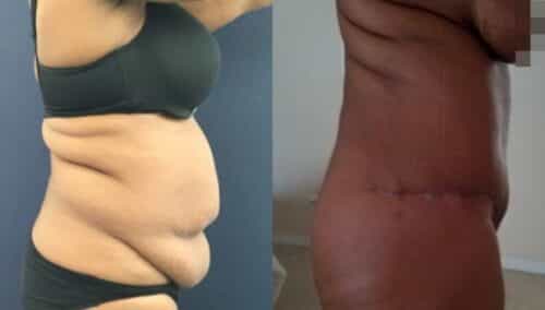 tummy tuck colombia 262-3-min