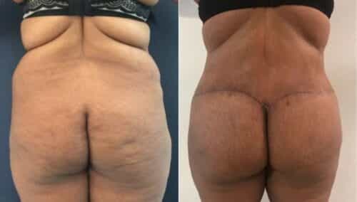tummy tuck colombia 263-1-min