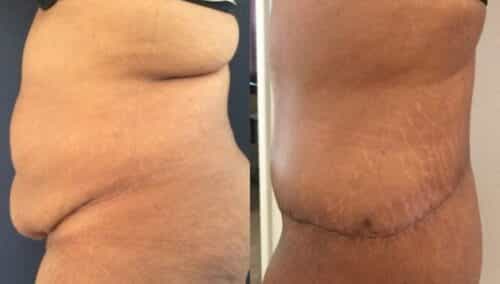tummy tuck colombia 263-2-min