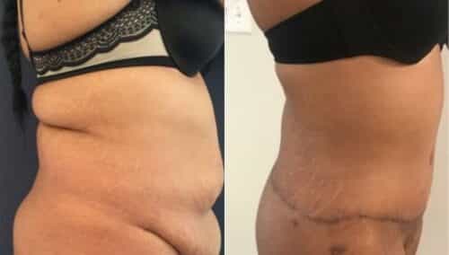 tummy tuck colombia 263-3-min