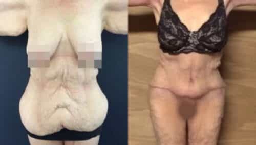 tummy tuck colombia 264-1-min