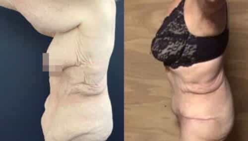 tummy tuck colombia 264-2-min