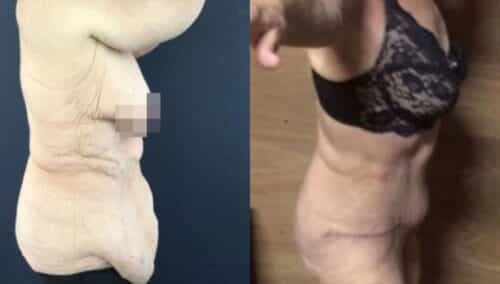 tummy tuck colombia 264-3-min