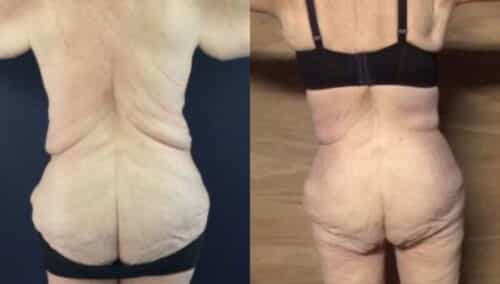 tummy tuck colombia 264-4-min