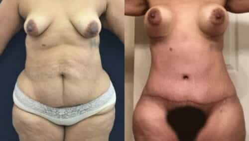 tummy tuck colombia 265-1-min
