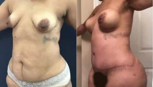 tummy tuck colombia 265-2-min
