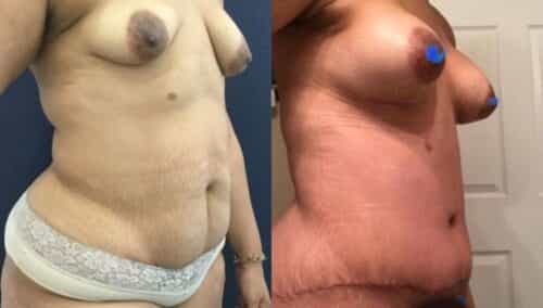 tummy tuck colombia 265-4-min