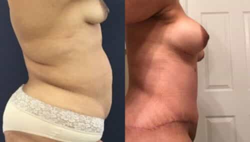 tummy tuck colombia 265-5-min