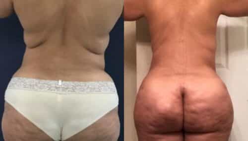 tummy tuck colombia 265-6-min