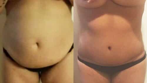 tummy tuck colombia 266-1-min