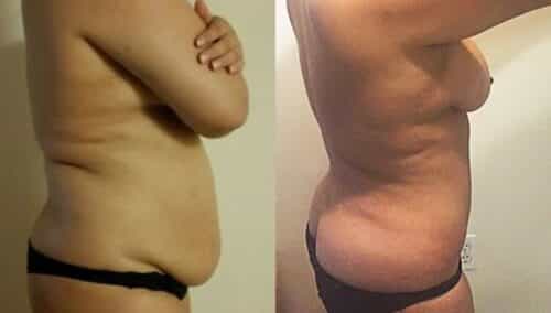 tummy tuck colombia 266-2-min