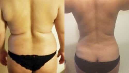 tummy tuck colombia 266-3-min