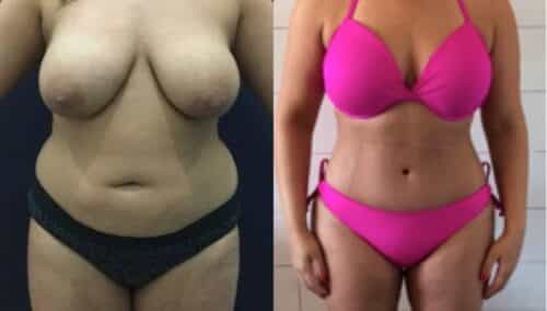 tummy tuck colombia 271-1-min