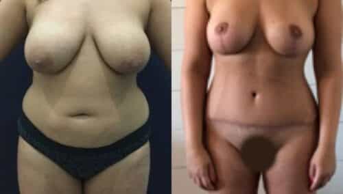 tummy tuck colombia 271-2-min