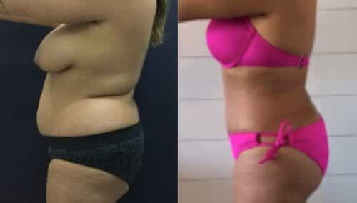 tummy tuck colombia 271-3-min