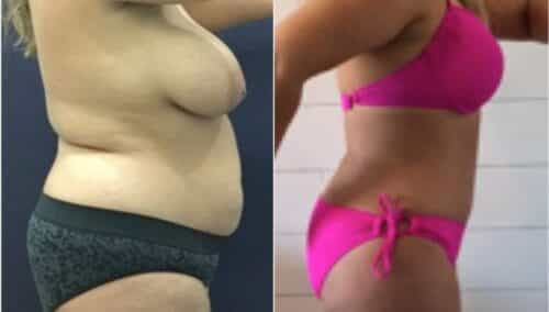 tummy tuck colombia 271-4-min