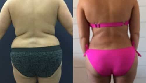 tummy tuck colombia 271-5-min