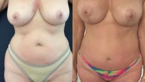tummy tuck colombia 274-1-min