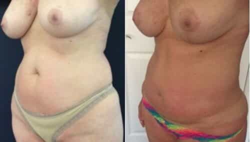 tummy tuck colombia 274-2-min