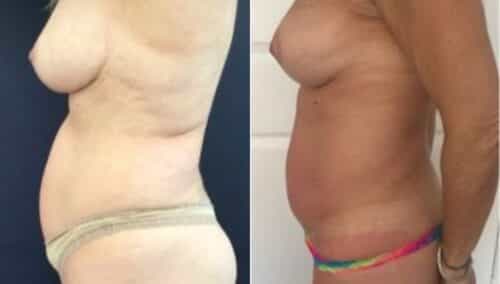 tummy tuck colombia 274-3-min