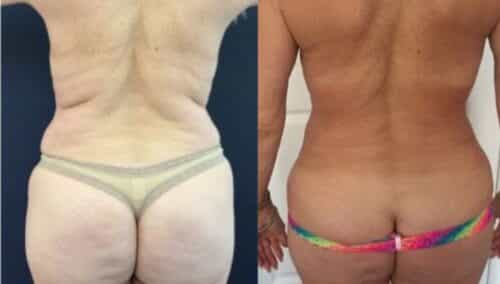 tummy tuck colombia 274-4-min