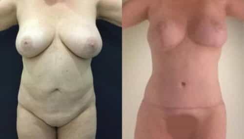 tummy tuck colombia 282-1-min