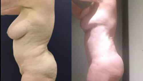 tummy tuck colombia 282-2-min
