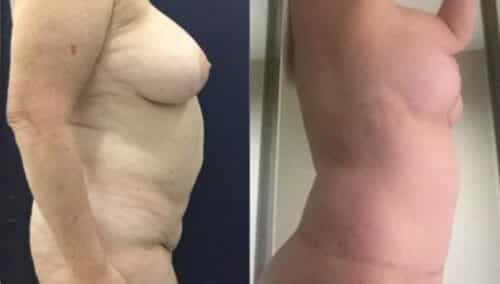 tummy tuck colombia 282-3-min