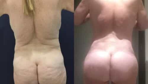 tummy tuck colombia 282-4-min