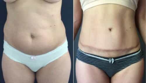 tummy tuck colombia 284-1-min