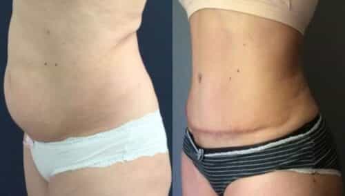 tummy tuck colombia 284-2-min