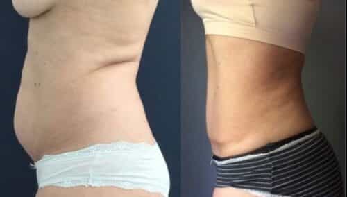 tummy tuck colombia 284-3-min