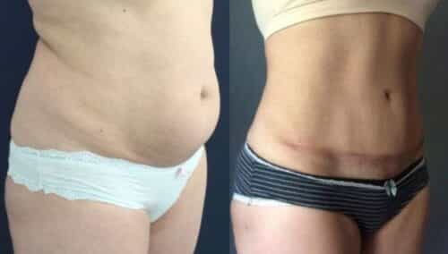 tummy tuck colombia 284-4-min
