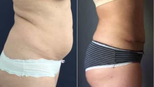 tummy tuck colombia 284-5-min