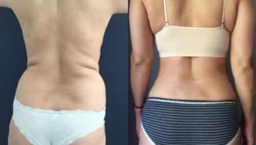 tummy tuck colombia 284-6-min