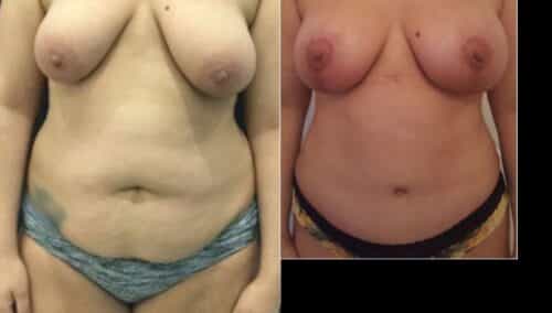 tummy tuck colombia 288-1-min