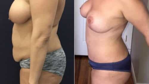 tummy tuck colombia 288-3-min