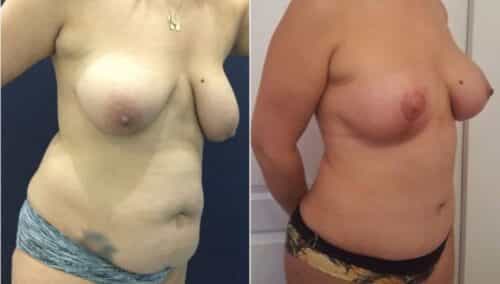 tummy tuck colombia 288-4-min